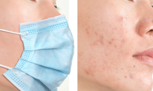 Maskne and Breakouts From Face Masks: Causes and Simple Fixes