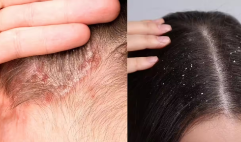 Scalp Care Basics: Dandruff, Itchiness and Product Build-Up Explained