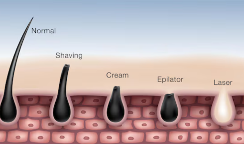 Shaving, Waxing, Creams and Laser