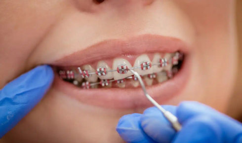  Retainer Care After Braces: How Long to Wear and How to Clean Them